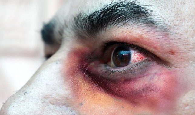 Hongo negro: se registró la primera muerte en Argentina