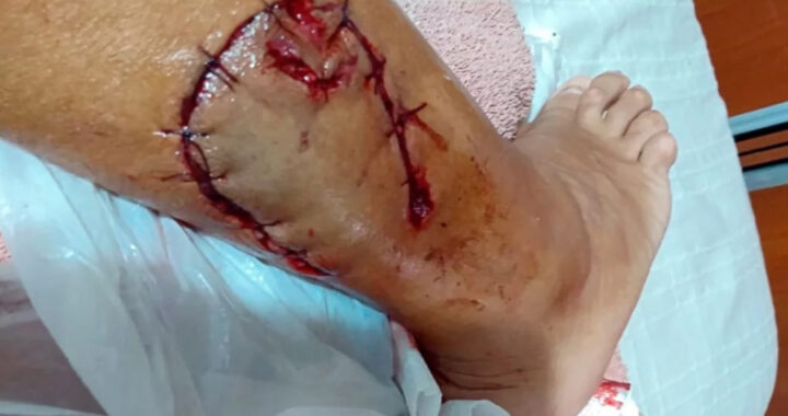 Santa Rosa: Un pitbull cruza con dogo atacó brutalmente a una mujer