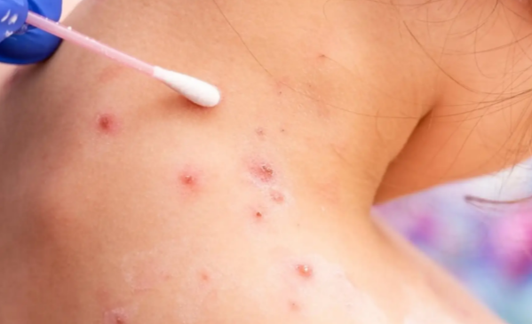 La OMS declaró alerta sanitaria por la viruela del mono