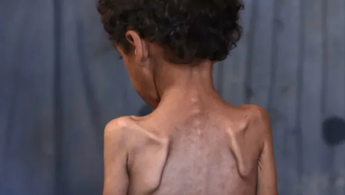 900 mil niños pasan hambre en Gaza por el bloqueo israeló y hasta los médicos se desmayan por la falta de alimentos